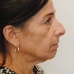 Face And Neck Lift Before & After Patient #1007