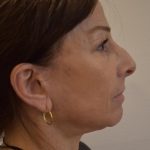Face And Neck Lift Before & After Patient #1007