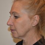 Face And Neck Lift Before & After Patient #1009