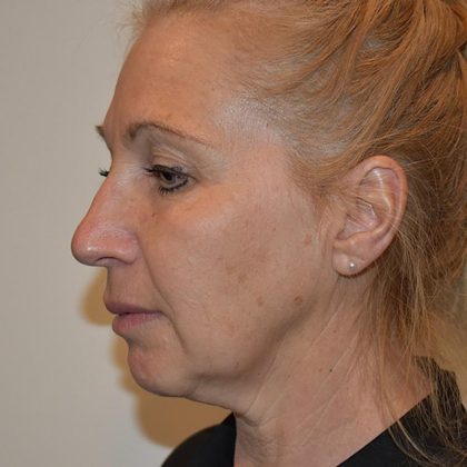 Face And Neck Lift Before & After Patient #1009