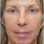 Facelift Before & After Patient #1603