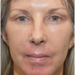 Facelift Before & After Patient #1603
