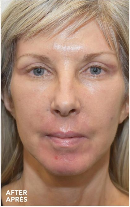 Facelift Before & After Patient #1603