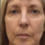 Facelift Before & After Patient #1603