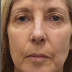 Facelift Before & After Patient #1603