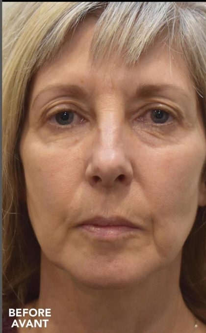 Facelift Before & After Patient #1603