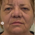 Facelift Before & After Patient #1604