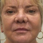Facelift Before & After Patient #1604