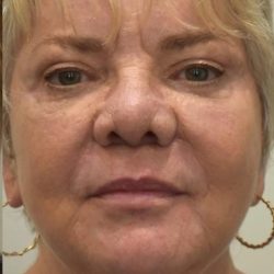 Facelift Before & After Patient #1604