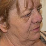 Facelift Before & After Patient #1604