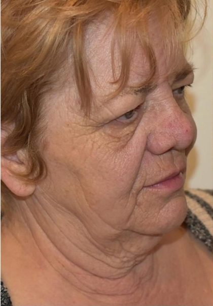 Facelift Before & After Patient #1604