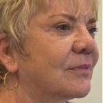Facelift Before & After Patient #1604