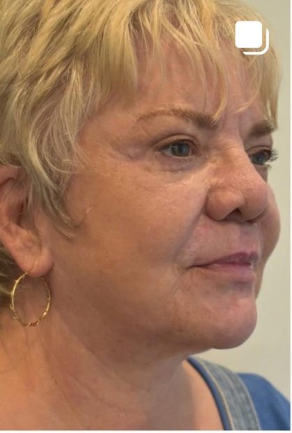 Facelift Before & After Patient #1604