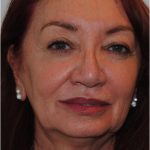 Facelift Before & After Patient #1605