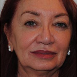 Facelift Before & After Patient #1605