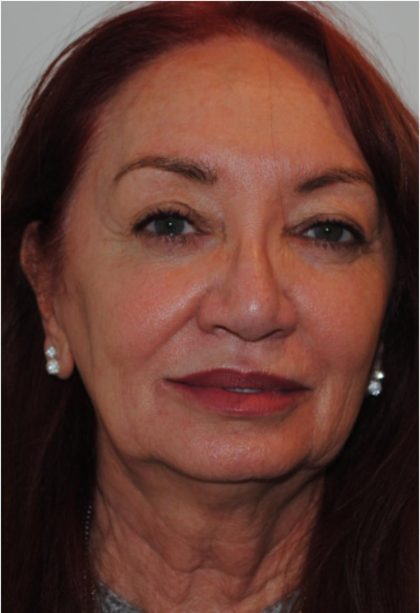 Facelift Before & After Patient #1605