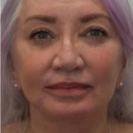 Facelift Before & After Patient #1605