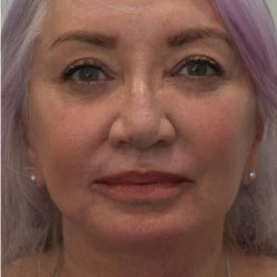 Facelift Before & After Patient #1605