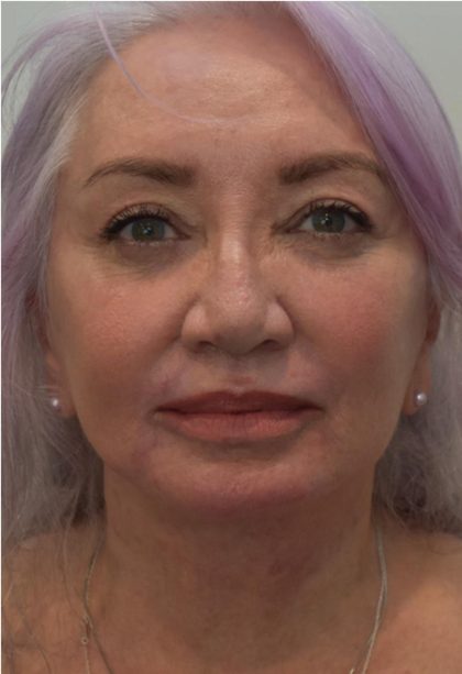 Facelift Before & After Patient #1605