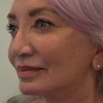 Facelift Before & After Patient #1605