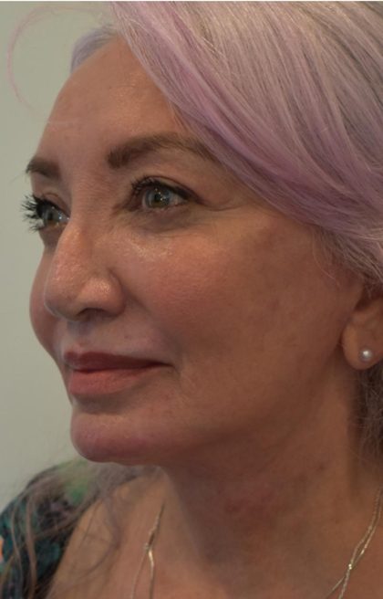 Facelift Before & After Patient #1605