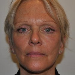 Facelift Before & After Patient #1608