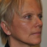 Facelift Before & After Patient #1608