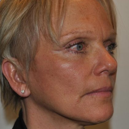 Facelift Before & After Patient #1608