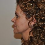 Facelift Before & After Patient #1594