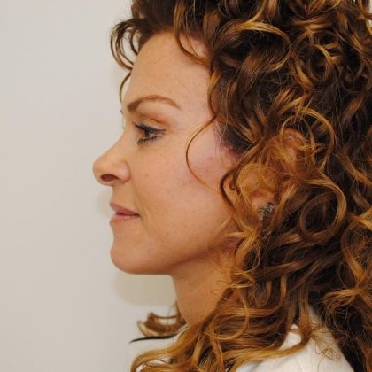 Facelift Before & After Patient #1594