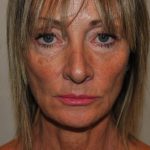 Facelift Before & After Patient #1595