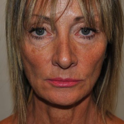 Facelift Before & After Patient #1595