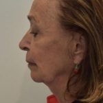 Facelift Before & After Patient #1596