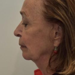 Facelift Before & After Patient #1596
