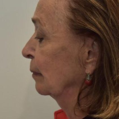 Facelift Before & After Patient #1596