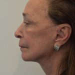 Facelift Before & After Patient #1596