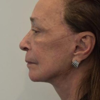 Facelift Before & After Patient #1596