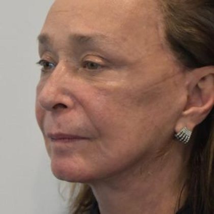 Facelift Before & After Patient #1596