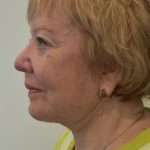 Facelift Before & After Patient #1598