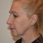 Facelift Before & After Patient #1599
