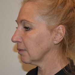 Facelift Before & After Patient #1599