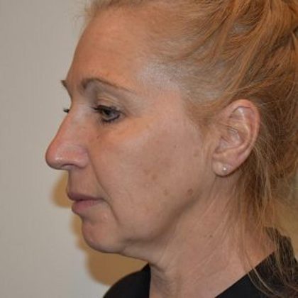 Facelift Before & After Patient #1599