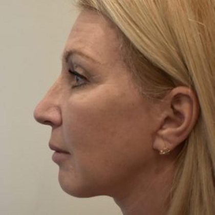 Facelift Before & After Patient #1599
