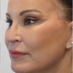 Facelift Before & After Patient #1602