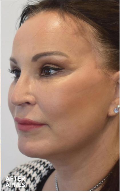 Facelift Before & After Patient #1602