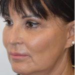 Facelift Before & After Patient #1602