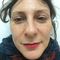 Fillers Before & After Patient #1010