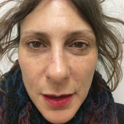 Fillers Before & After Patient #1010