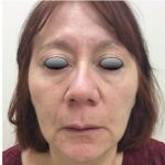 Fillers Before & After Patient #1011