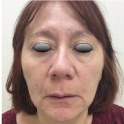 Fillers Before & After Patient #1011